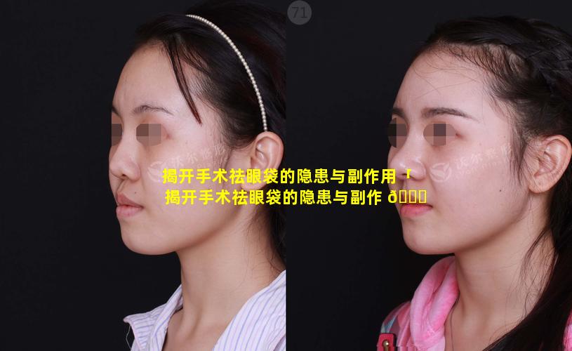 揭开手术祛眼袋的隐患与副作用「揭开手术祛眼袋的隐患与副作 🕊 用是什么」